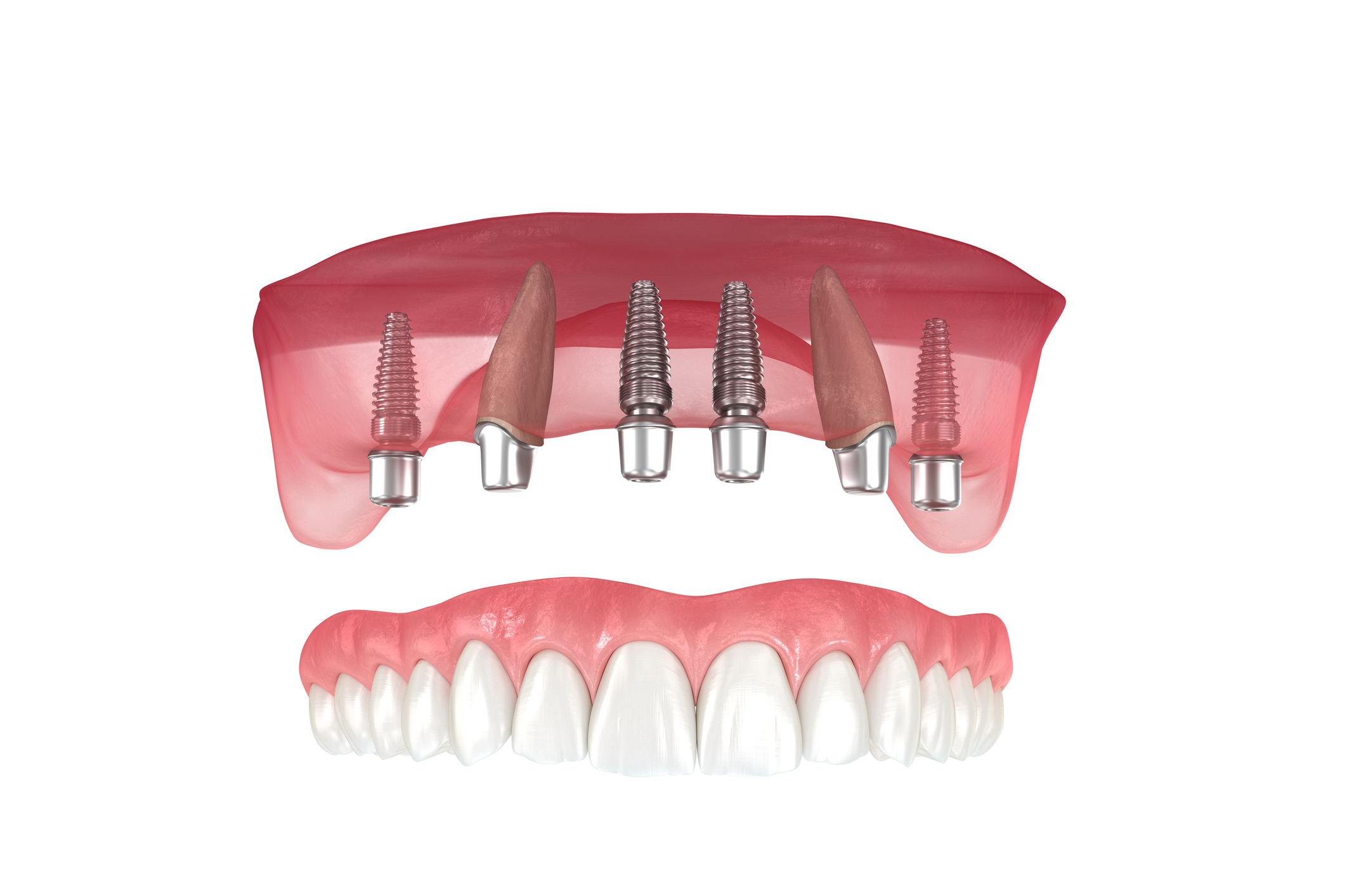 All-on-4 dental implants