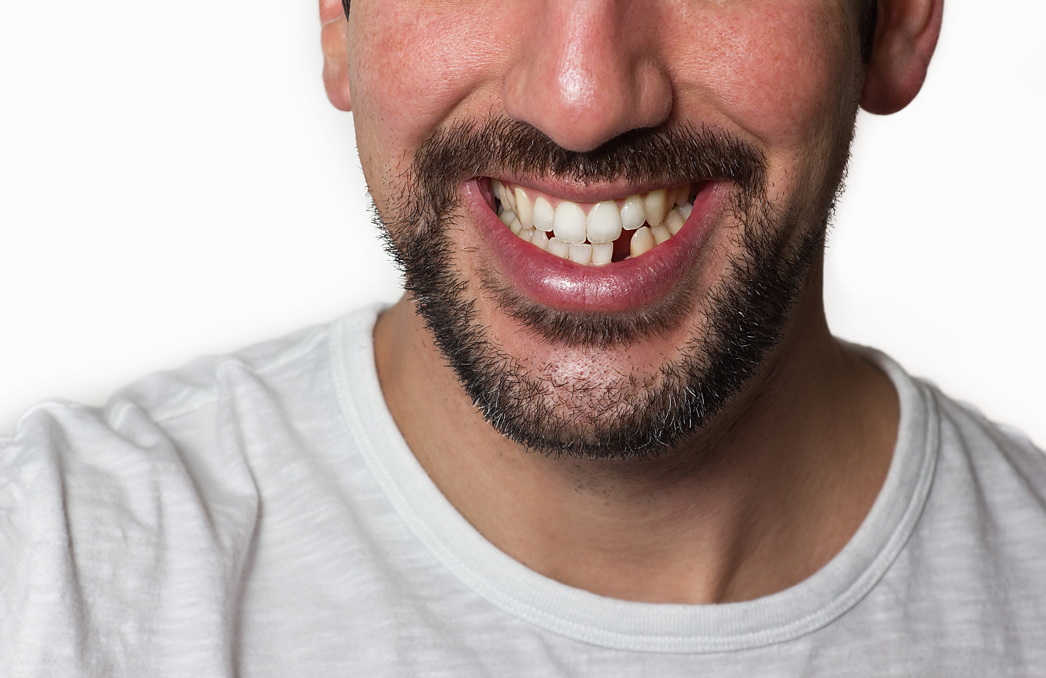 Replace missing teeth with All-on-4 dental implants
